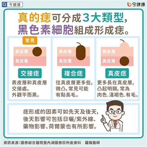 身體多痣|痣是什麼？一次了解痣原因、就醫時機以及如何改善